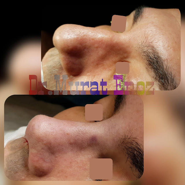 Rhinoplasty in men istanbul - Male nose job