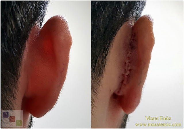 Modifiye teknik kepçe kulak ameliyatı -  Modifiye teknik otoplasti ameliyatı – Modifiye teknik kulak kepçesi estetiği fiyatı - Otoplasti - Modifiye teknik kepçe kulak estetiği - Kepçe kulak estetiği öncesi ve sonrası - Kepçe kulak düzeltme fotoğrafları – Modifiye teknikle kepçe kulak estetiği – Kepçe kulak ameliyatı olanlar - Modifiye teknik kepçe kulak operasyonu
