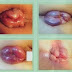 Obat Ambeien Menyusui thumbnail
