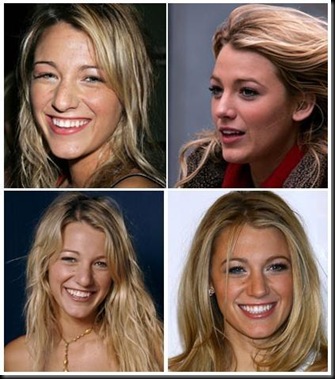 blake lively before and after nose job. lake lively before and after