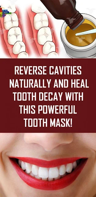 Reverse Tooth Decay and Heal Cavities With These Powerful Home Remedies!