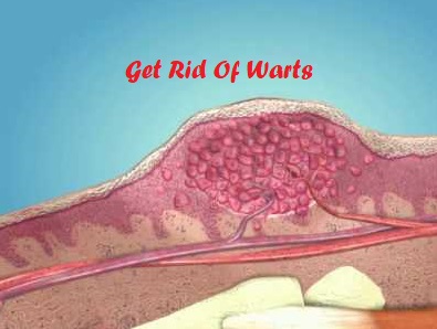 Get Rid Of Warts