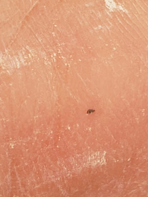 black dot from wasp sting