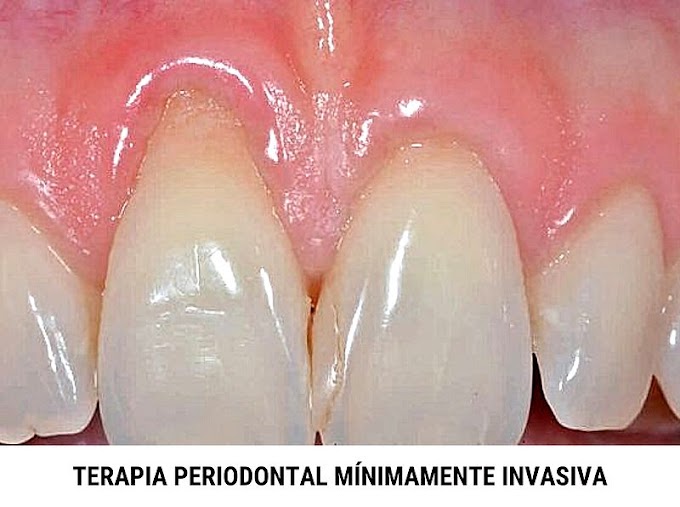 PDF: Eficacia de la terapia periodontal mínimamente invasiva en defectos intraóseos periodontales - 2022