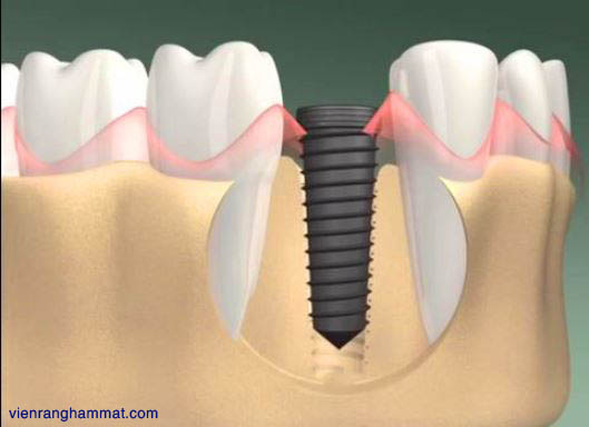 Trồng răng implant có đau không thưa bác sĩ