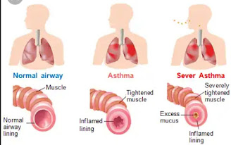 Causes, symptoms and home remedies for asthma