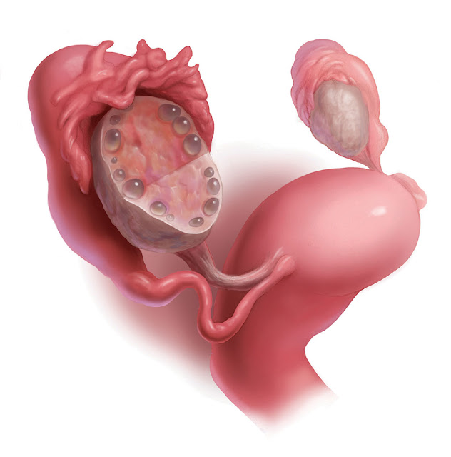 Polycystic Ovary Syndrome Treatment Market