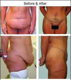 Plastic Surgery After Weight Loss