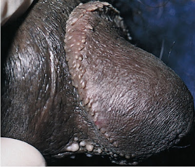 22–28. Pearly penile papules and Tyson glands. There are numerous pearly penile papules along the corona of the glans penis; the larger white papules on the ventral surface below the glans are Tyson glands.