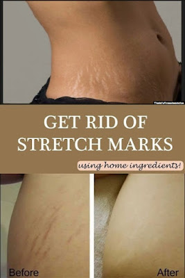 stretch-marks-removal-cream