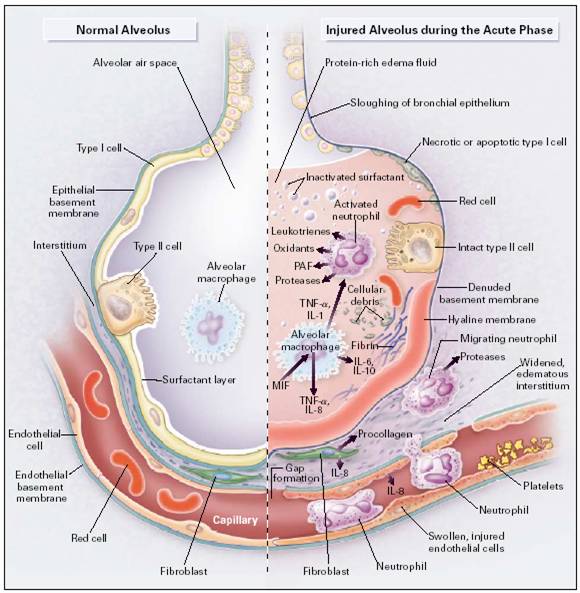 Nursing Diagnosis for ARDS  Acute Respiratory Distress Syndrome 