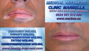 CURA PARA VITILIGO clínica estética maquillaje semipermanente propone Vitiligo Cura