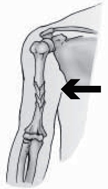 Gambar 1. Fraktura Berganda