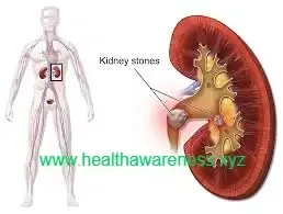 Kidney Stones Causes