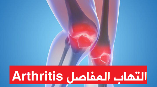 التهاب المفاصل arthritis