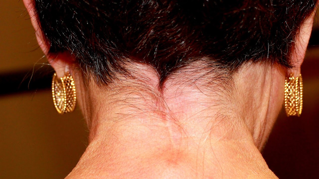 Neck Lift Nyc