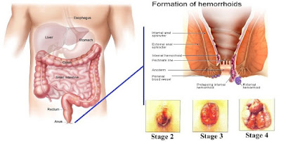 Mengatasi Wasir Ambeien