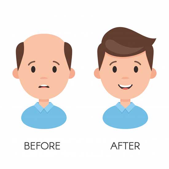 benefits of Hair Transplant surgery I hair loss before after