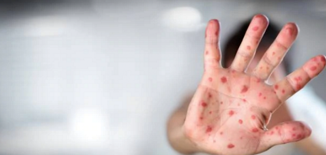 Measles “destroys immune system memory”
