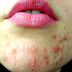 Acne Treatment With Doxycycline Buy Essay Custom Can Minocycline Make
Your Acne Worse