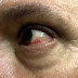 The danger thing for people of subconjunctival hematoma