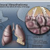 The Dangerous Mesothelioma Lung Cancer