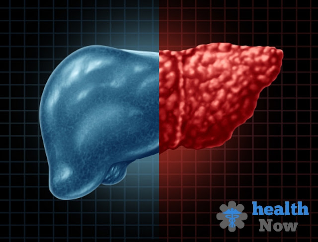 Liver cancer :treatment causes and diagnosis.