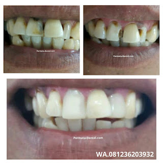 foto, gambar, gigi depan hitam Permata Dental Bali| sebelum dan sesudah gigi hitam diperbaiki di Permata Dental Bali | foto gigi keropos hitam Permata Dental Bali |gigi hitam karena sakit | gigi hitam berlubang di Permata Dental Bali | gigi hitam depan di Permata Dental Bali | gigi hitam bagian belakang | foto gigi hitam yang sudah diperbaiki Permata Dental Bali |  gigi hitam bagian depan| foto gigi keropos dan hitam, foto gigi hitam oleh Permata Dental Bali , Bali Hits, Bali banget, area Bali, Bali  kota, area kampus Bali. veneer gigi hitam Bali | gambar sebelum dan sesudah veneer gigi hitam dan berlubang  veneer gigi hitam Bali | veneer gigi hitam denpasar| veneer gigi hitam nusadua | veneer gigi hitam ngurahrai| veneer gigi hitam badung| veneer gigi hitam jember jimbaran| veneer gigi hitam gatsu| veneer gigi hitam bali | veneer gigi hitam bagus di Permata Dental Bali | veneer gigi hitam baik di Permata Dental Bali | veneer gigi hitam cepat di Permata Dental Bali | veneer gigi hitam murah di Permata Dental Bali | veneer gigi hitam aman di Permata Dental Bali | veneer gigi hitam mudah di Permata Dental Bali | veneer gigi hitam promo Permata Dental Bali | gambar veneer gigi hitam Permata Dental Bali | gambar sebelum dan sesudah veneer gigi hitam dan berlubang Permata Dental Bali | veneer gigi hitam bagus | veneer gigi hitam baik | veneer gigi hitam cepat | veneer gigi hitam murah| veneer gigi hitam aman | veneer gigi hitam mudah  | veneer gigi hitam promo | gambar veneer gigi hitam | gambar sebelum dan sesudah veneer gigi hitam dan berlubang Permata Dental Bali | foto veneer gigi hitam Permata Dental Bali |perbaiki gigi hitam Permata Dental Bali | cara mengatasi gigi hitam Permata Dental Bali | menghilangkan gigi hitam Permata Dental Bali | cara menghilangkan gigi hitam Permata Dental Bali | cara memutihkan  gigi hitam Permata Dental Bali | membantu menghilangkan gigi hitam Permata Dental Bali | perbaiki Permata Dental Bali | harga perbaiki gigi hitam Permata Dental Bali | perbaiki gigi hitam murah  Permata Dental Bali | perbaiki gigi hitam promo Permata Dental Bali | perbaiki gigi hitam bagus Permata Dental Bali | perbaiki gigi hitam  aman Permata Dental Bali | perbaiki gigi hitam cepat  Permata Dental Bali | perbaiki gigi hitam mudah Permata Dental Bali | harga perbaiki gigi hitam mudah Permata Dental Bali | perbaiki gigi hitam Permata Dental Bali |proses perbaiki gigi hitam mudah Permata Dental Bali | foto perbaiki gigi hitam Permata Dental Bali | gambar perbaiki gigi hitam Permata Dental Bali | perbaiki gigi hitam mudah Permata Dental Bali | perbaiki  gigi hitam bali| perbaiki  gigi hitam denpasar  | perbaiki  gigi hitam nusadua| perbaiki  gigi hitam badung| perbaiki  gigi hitam ngurahrai| perbaiki  gigi hitam gatsu| perbaiki  gigi hitam jimbaran| perbaiki  gigi hitam tabanan| perbaiki  gigi hitam