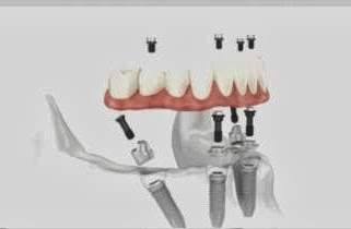 All on Four Dental Implants