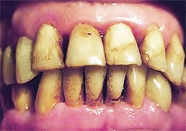 <Img src ="Tinción_por_Clorhexidina.gif" width = "270" height "190" border = "0" alt = "Imagen de coloración amarilla de dientes y lengua por clorhexidina">