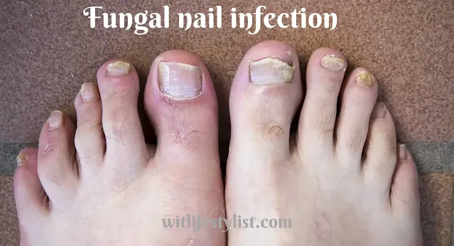 Witlifestylist, Fungal nail infection, nail infection, nail infection on feet,