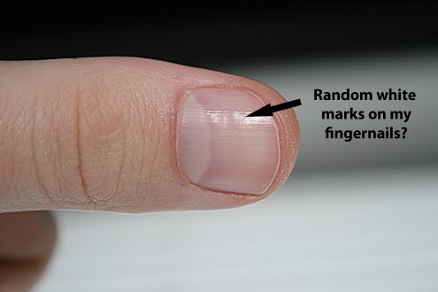 What Causes White Spots On Fingernail Beds