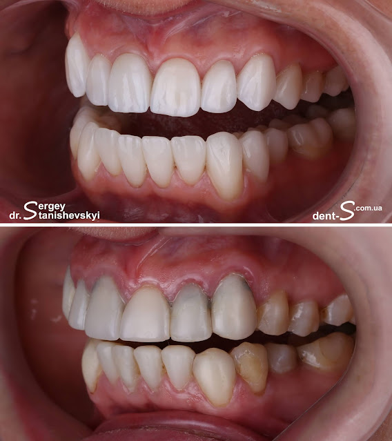 стоматолог стоматология Виниры Киев Станишевский Сергей накладки коронки керамика керамические