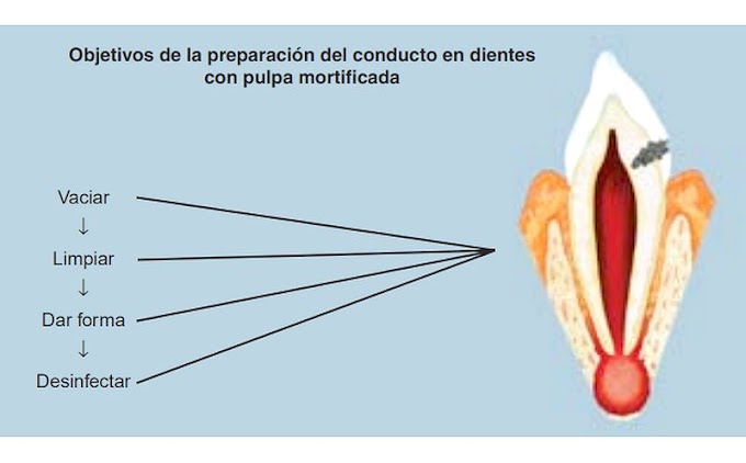 PDF: Preparación del conducto radicular: limpieza y conformación