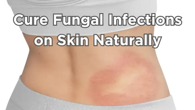 How to Cure Fungal Infection on Skin Naturally