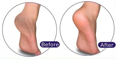 My Grandmother Told Me About This Trick. She Healed My Cracked Heels In One Night!