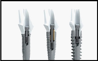 Dental Implants NJ - New Teeth One Day