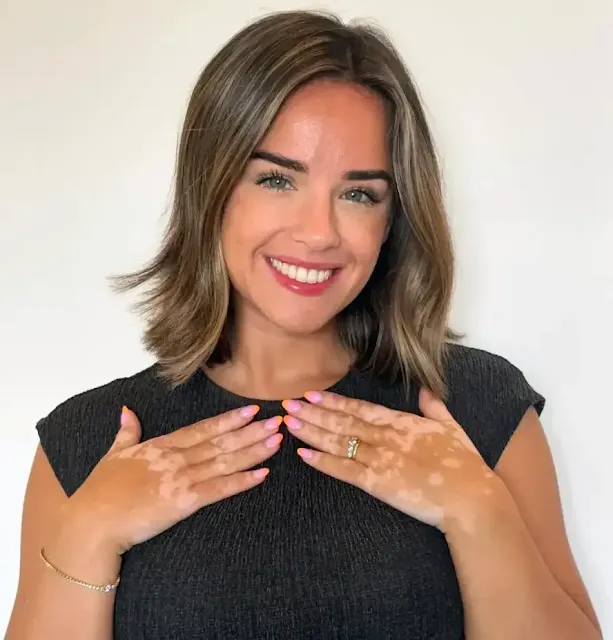 Actriz Georgia May Foote revela que tiene vitiligo: “Cada día avanza más”