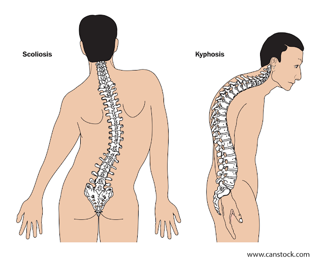 scoliosis