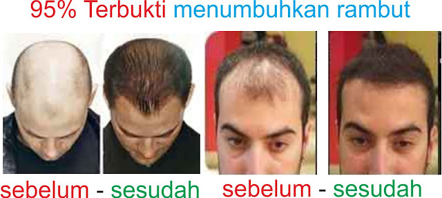 obat rambut, penumbuh rambut, obat bio hair, bio hair 123, obat herbal bio hair, penumbuh rambut herbal, penumbuh rambut bio hair 123