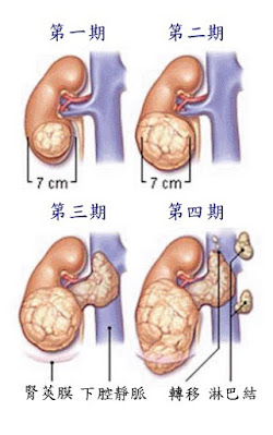 腎臟癌分期（ㄧ到四期）