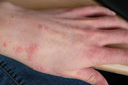 12 Most Effective Home Remedies for Scabies