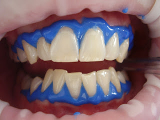 Miami Beach teeth whitening