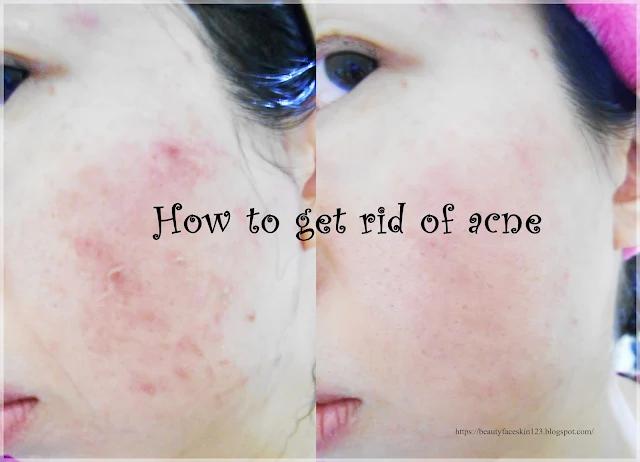 How I get rid of acne&Asian skincare tips for acne prone skin