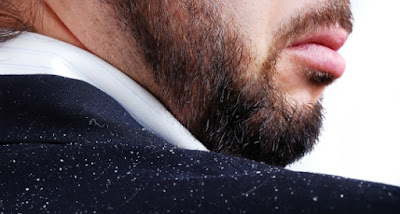 how to get rid of dandruff for guys