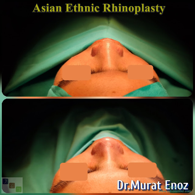 Asian Ethnic Nose Job - Asian Ethnic Rhinoplasty in Istanbul