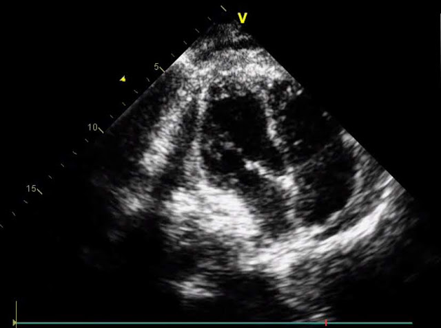 Figure 4: Echocardiographic evaluation after surgical repair of the free wall