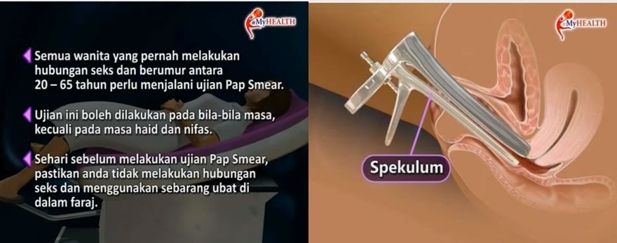 Amalini's diary: Pap Smear. Dah Buat Belum?