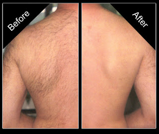 cost laser hair removal1
