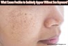 What Causes Freckles to Suddenly Appear Without Sun Exposure